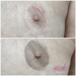 Micropigmentación de Areolas en Barcelona 42