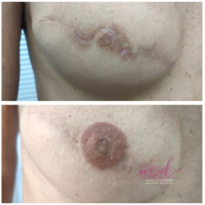 Micropigmentación de Areolas en Barcelona 2