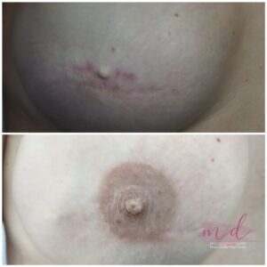 Micropigmentación de Areolas en Barcelona 3