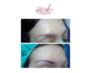 Micropigmentación facial: Correcciones 5